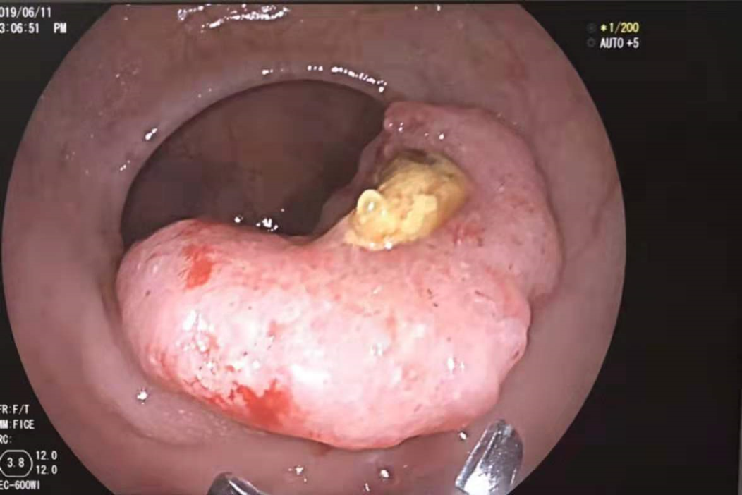 结肠镜检查可见肠腔内巨大肿物