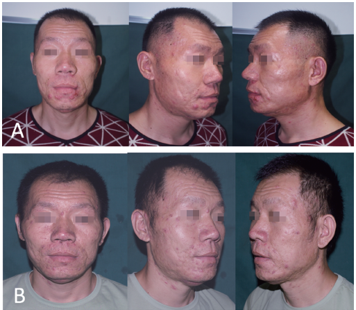以下颌骨骨髓炎为首发症状的sapho综合征5例临床分析
