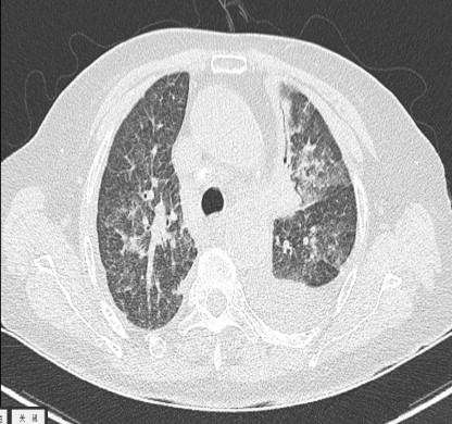 多发性肉芽肿性病变1例