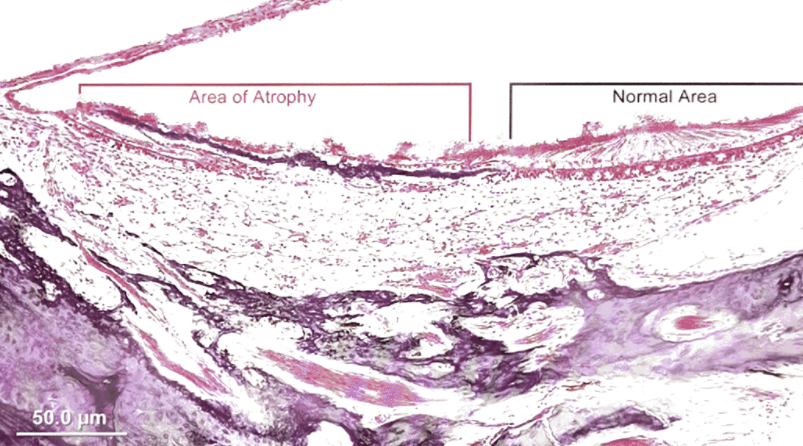 图14 椭圆囊斑耳石膜,可见部分区域耳石膜萎缩(area of atrophy)