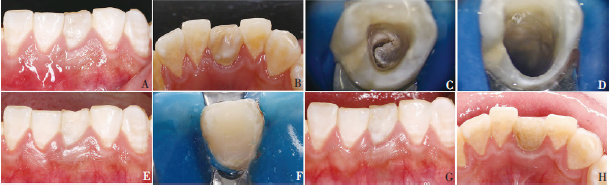 牙中牙3例报告及文献复习