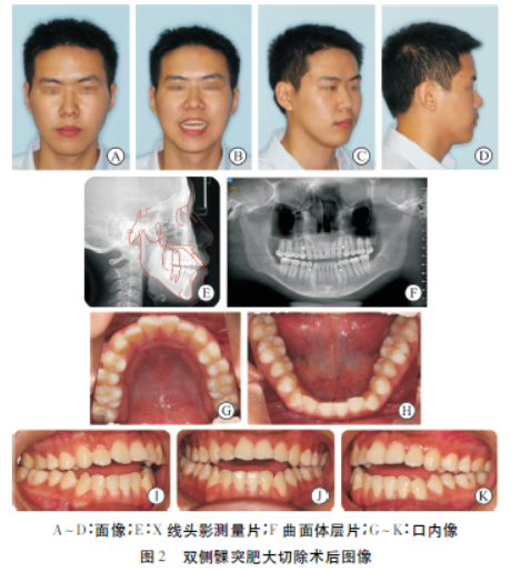双侧髁突肥大术后的正畸治疗1例